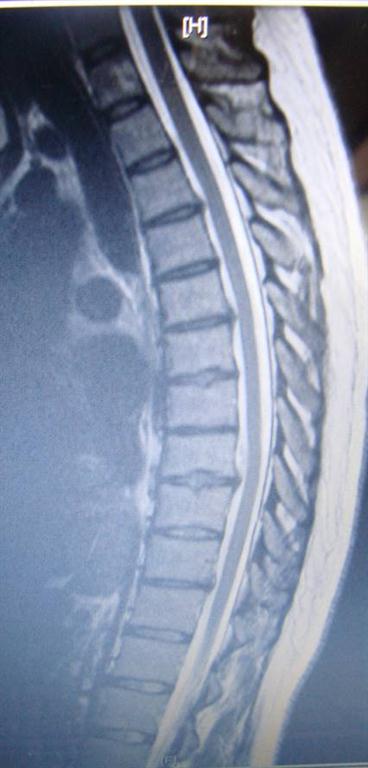 thoracic disc herniation treated by Augusta chiropractor